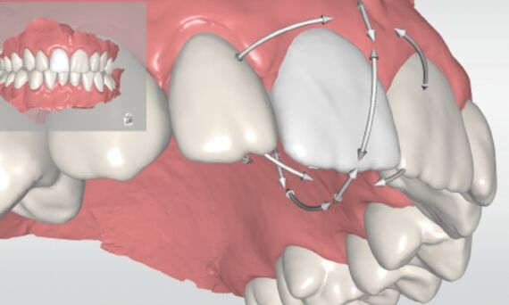 Single tooth movement with CEREC Ortho