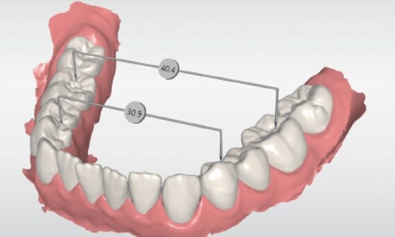 Measurement of distance between teeth